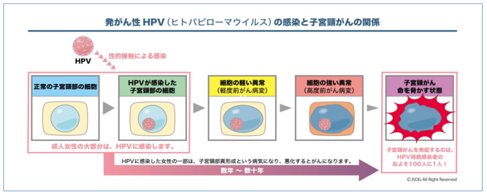 子宮頸がん