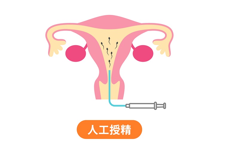 人工授精とは