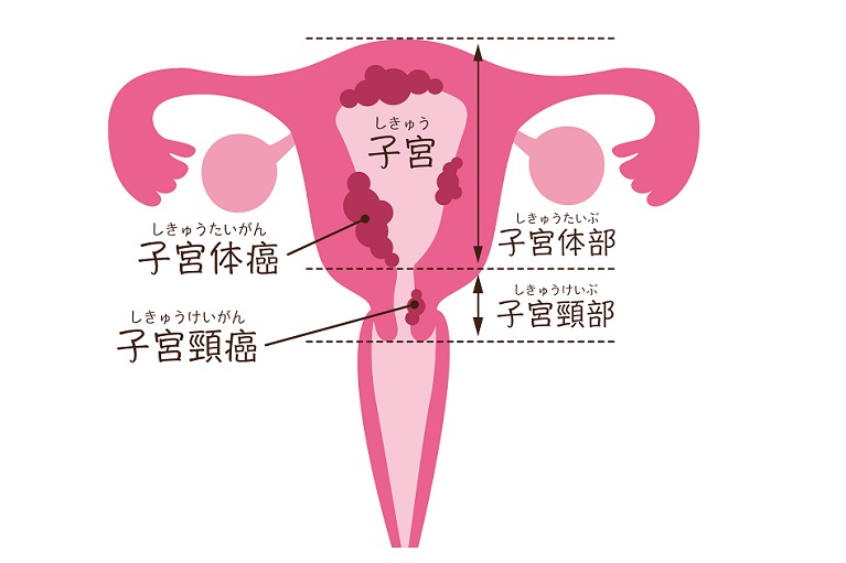 子宮頸がんとは