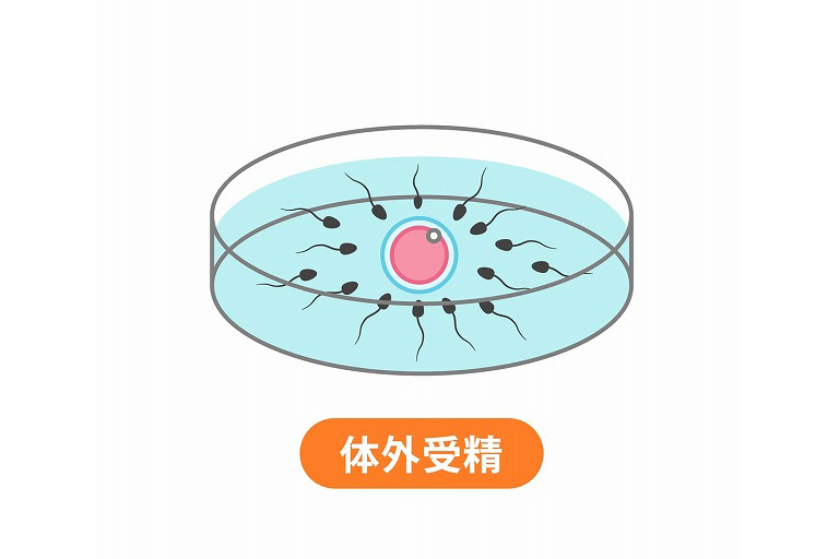 体外受精