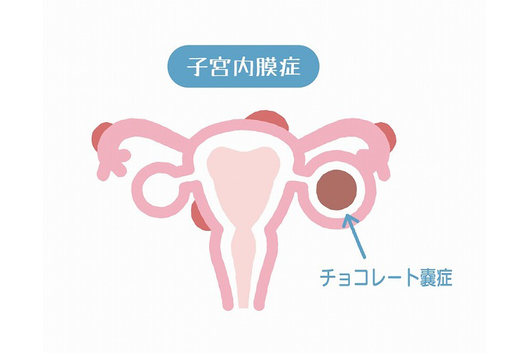 子宮内膜症とは