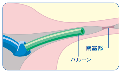 FTカテーテル