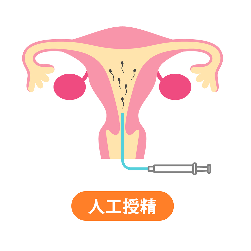 人工授精