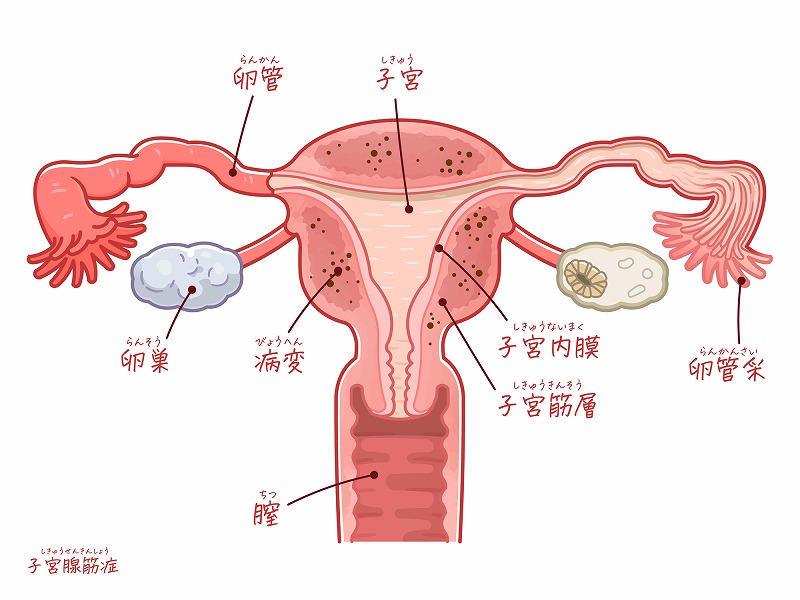 卵管閉塞（卵管狭窄）とはどのような状態なのか